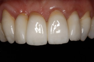 Conventional All Ceramic Bridge