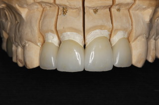 All Ceramic Crowns