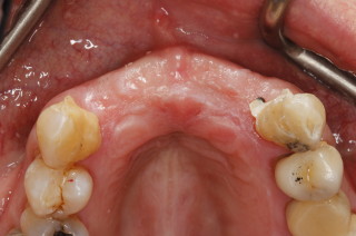 Resin Retained Bridge