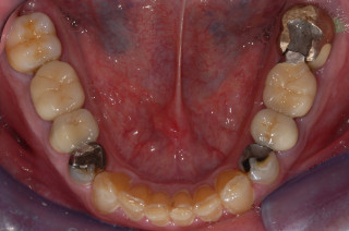 Posterior composite resin