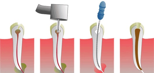 Root Canal Therapy